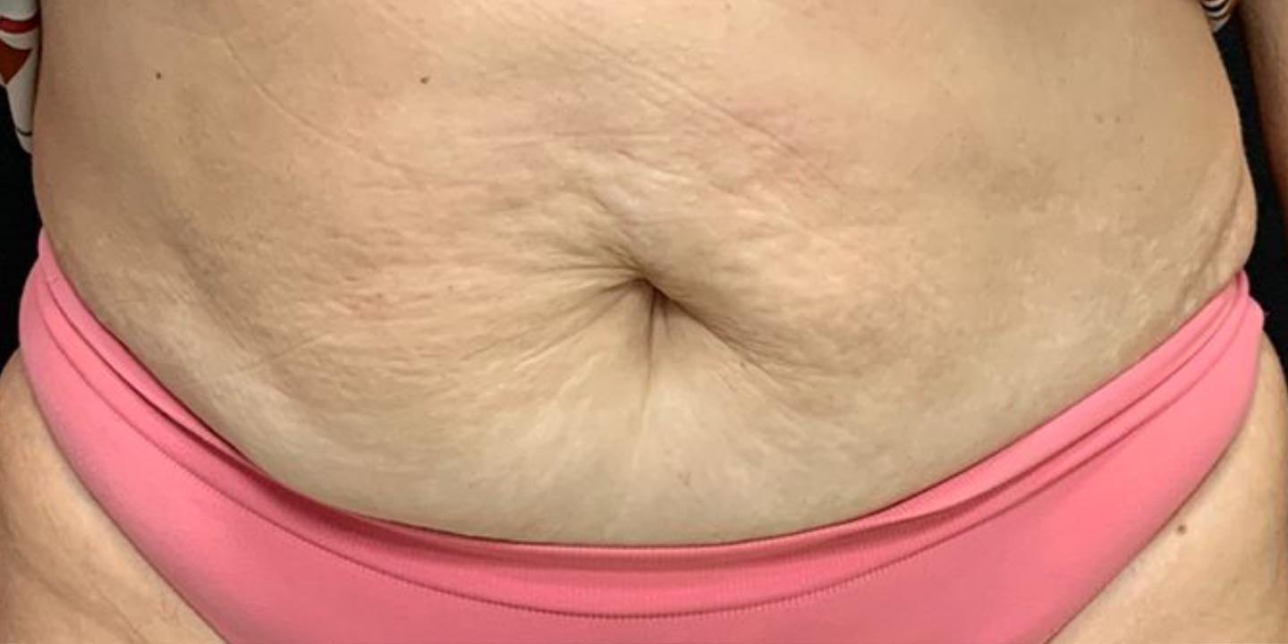 Antes — carboxiterapia