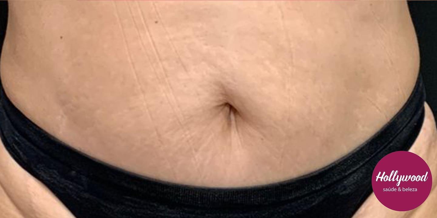 Depois — carboxiterapia