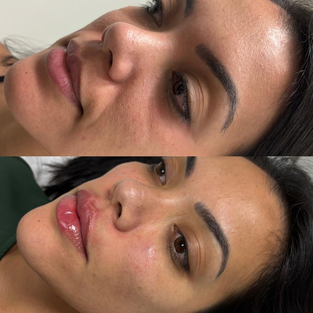 Harmonização facial