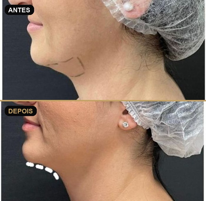 Crio de papada — antes e depois