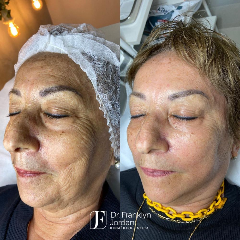 Sculptra